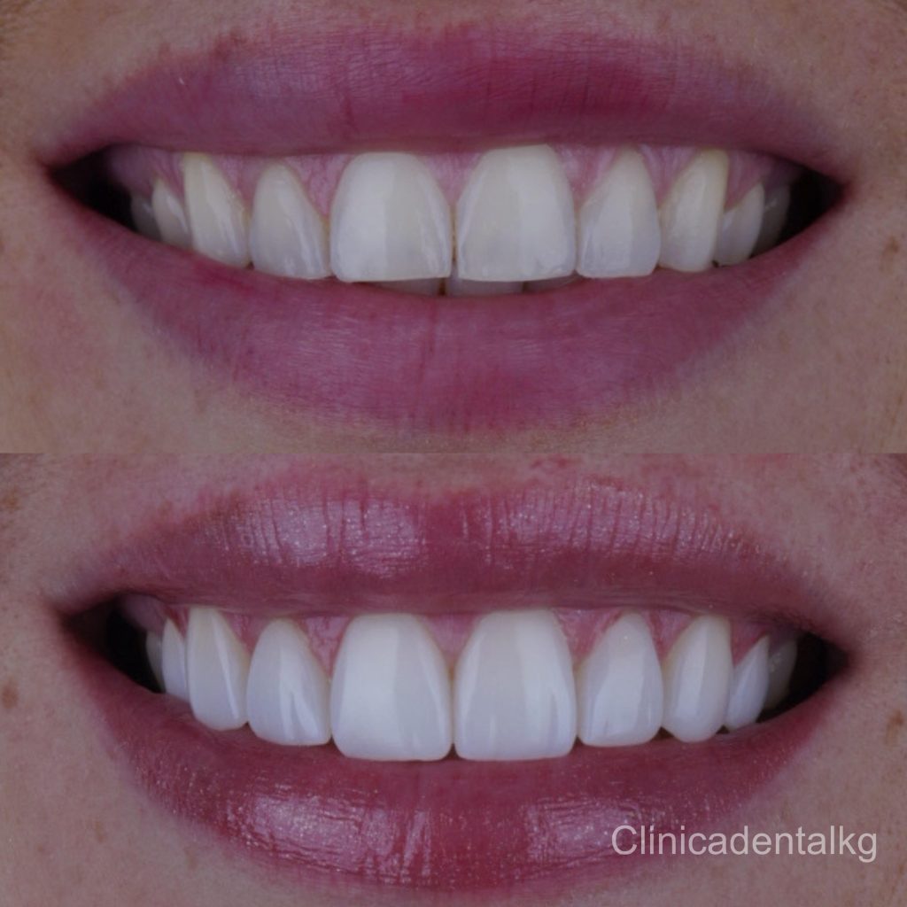 Antes Y Despues 6 1024x1024