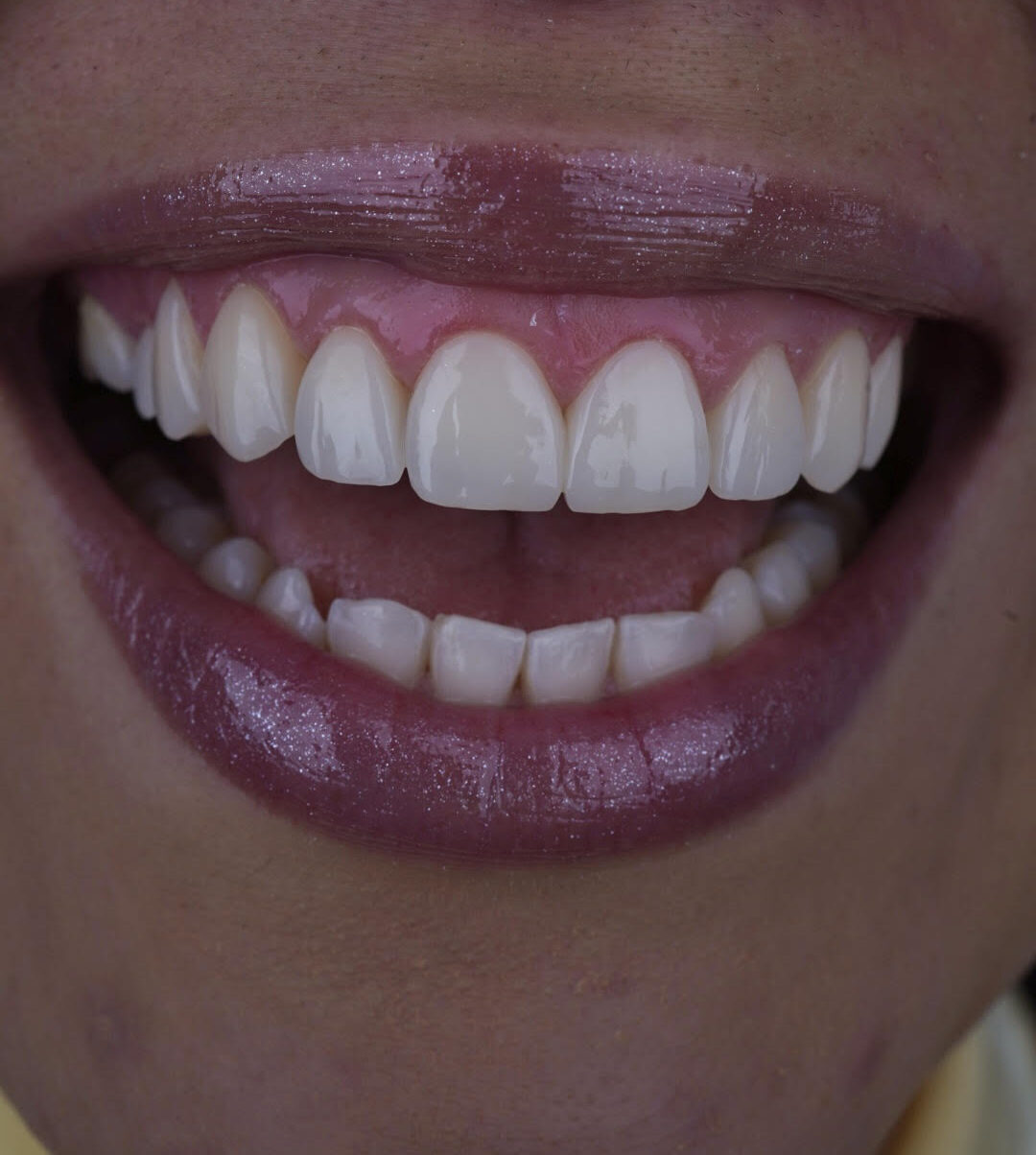 sonrisa 2